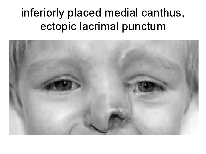 inferiorly placed medial canthus, ectopic lacrimal punctum 