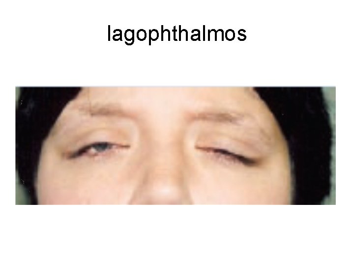 lagophthalmos 