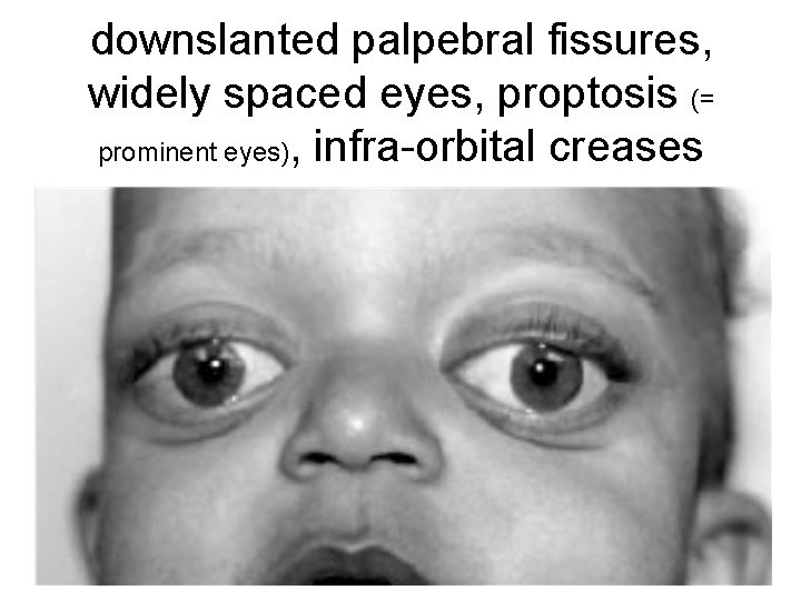 downslanted palpebral fissures, widely spaced eyes, proptosis (= prominent eyes), infra-orbital creases 