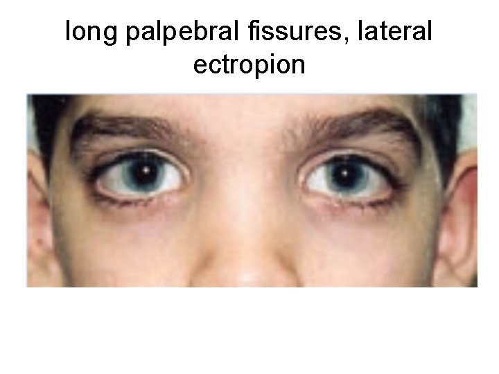 long palpebral fissures, lateral ectropion 