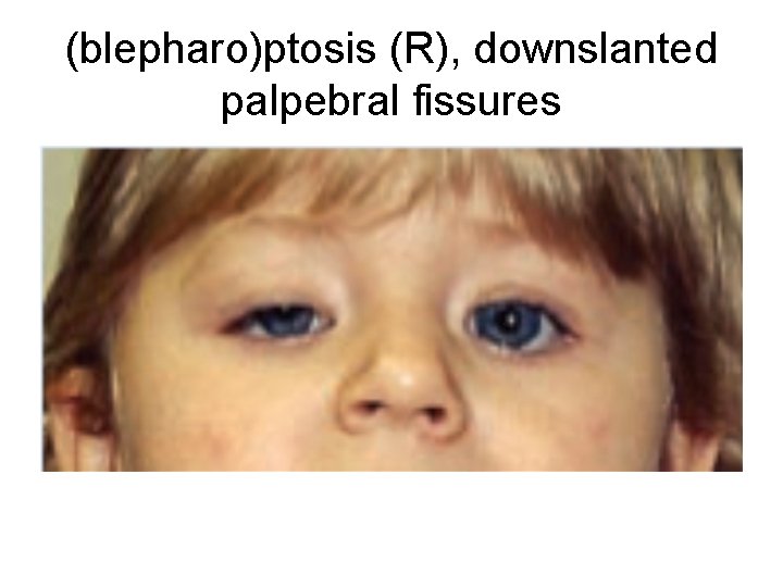 (blepharo)ptosis (R), downslanted palpebral fissures 