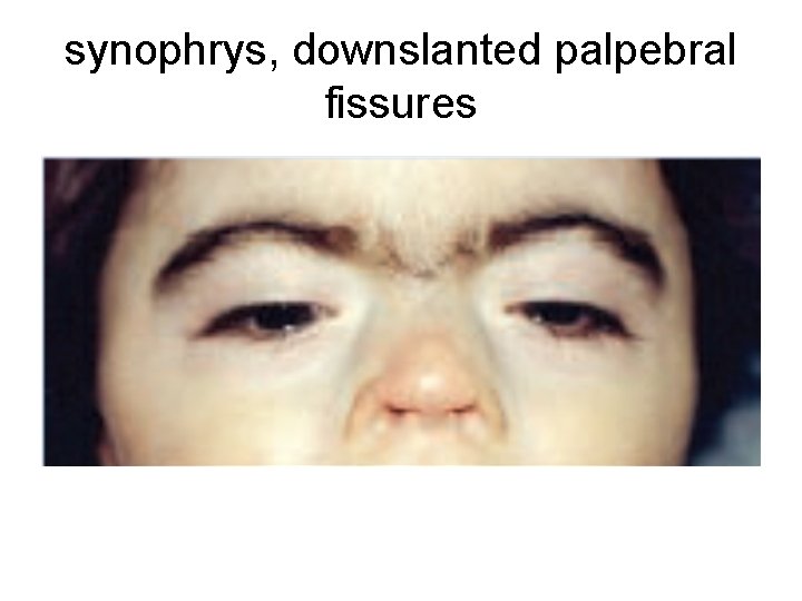 synophrys, downslanted palpebral fissures 