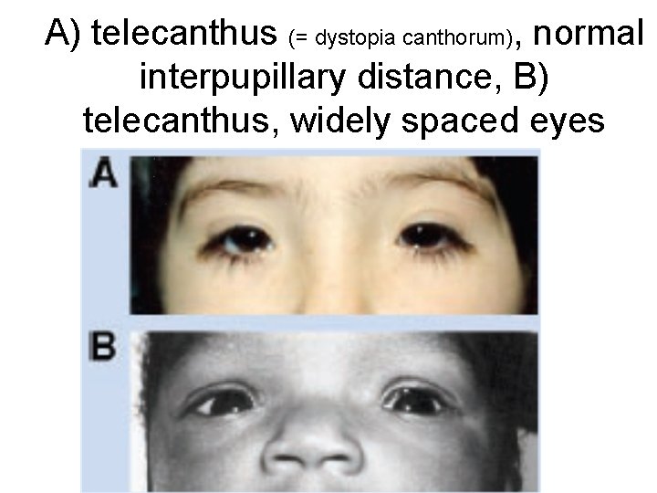 A) telecanthus (= dystopia canthorum), normal interpupillary distance, B) telecanthus, widely spaced eyes 