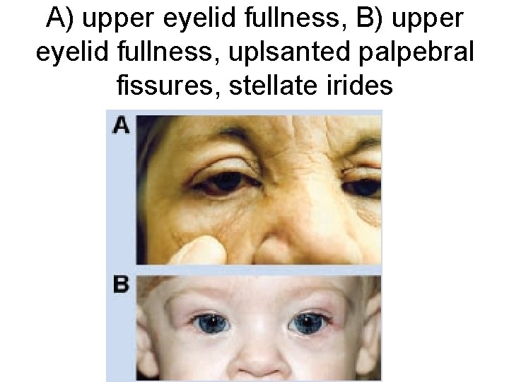 A) upper eyelid fullness, B) upper eyelid fullness, uplsanted palpebral fissures, stellate irides 