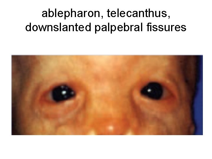 ablepharon, telecanthus, downslanted palpebral fissures 
