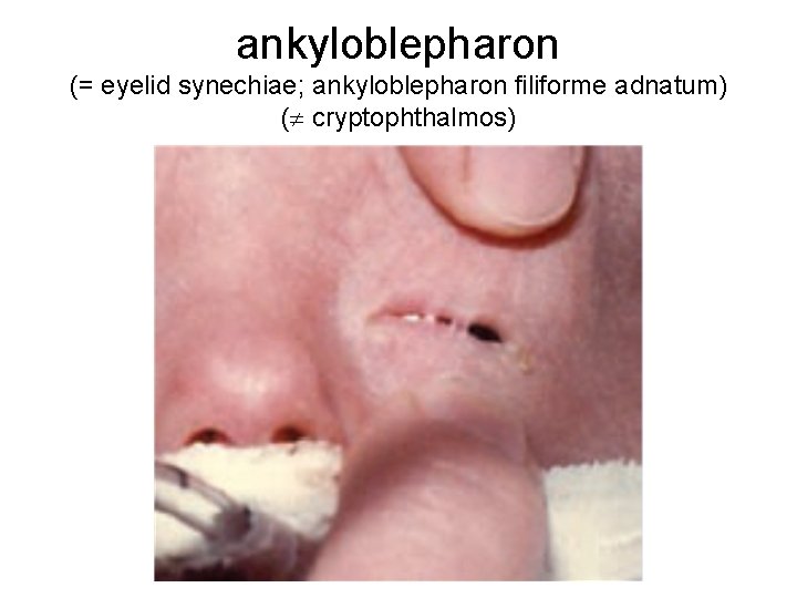 ankyloblepharon (= eyelid synechiae; ankyloblepharon filiforme adnatum) ( cryptophthalmos) 