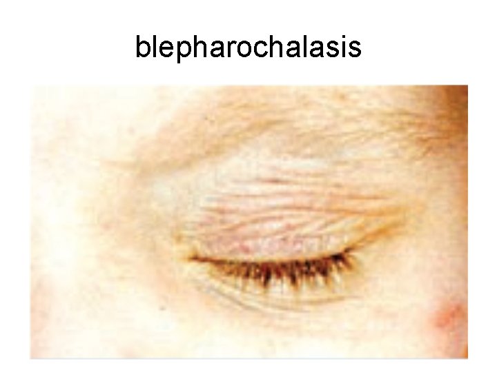 blepharochalasis 