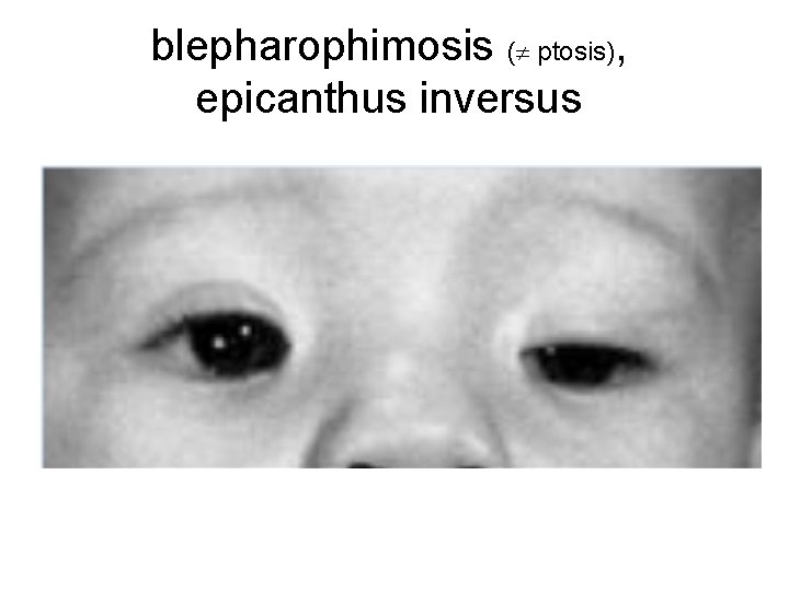 blepharophimosis ( ptosis), epicanthus inversus 