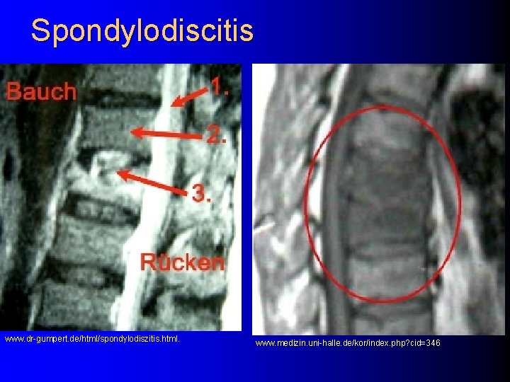 Spondylodiscitis www. dr-gumpert. de/html/spondylodiszitis. html. www. medizin. uni-halle. de/kor/index. php? cid=346 