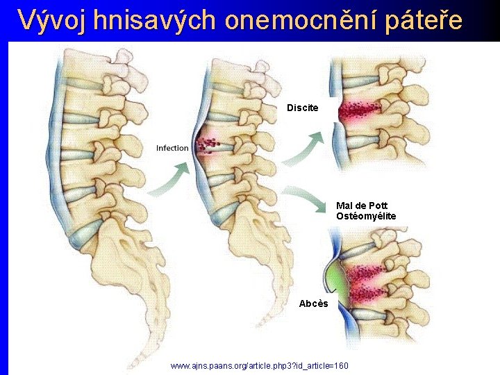 Vývoj hnisavých onemocnění páteře www. ajns. paans. org/article. php 3? id_article=160 