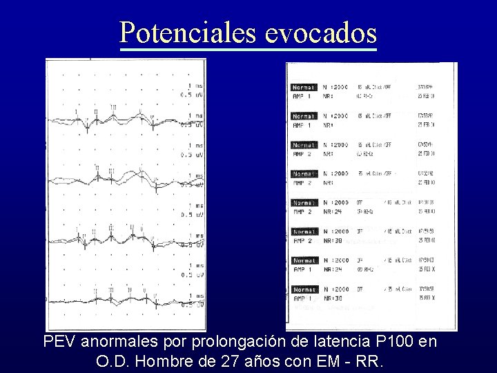 Potenciales evocados PEV anormales por prolongación de latencia P 100 en O. D. Hombre