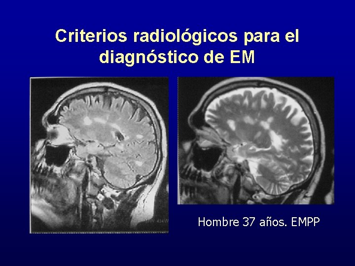 Criterios radiológicos para el diagnóstico de EM Hombre 37 años. EMPP 