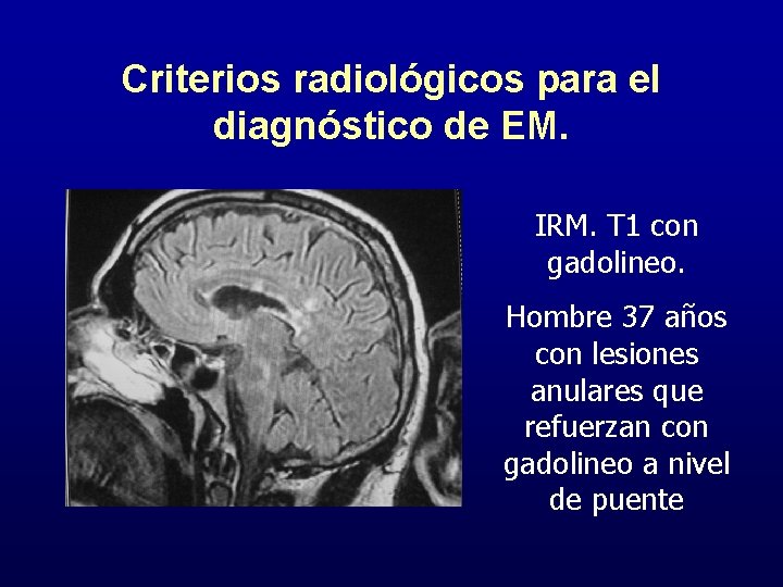 Criterios radiológicos para el diagnóstico de EM. IRM. T 1 con gadolineo. Hombre 37
