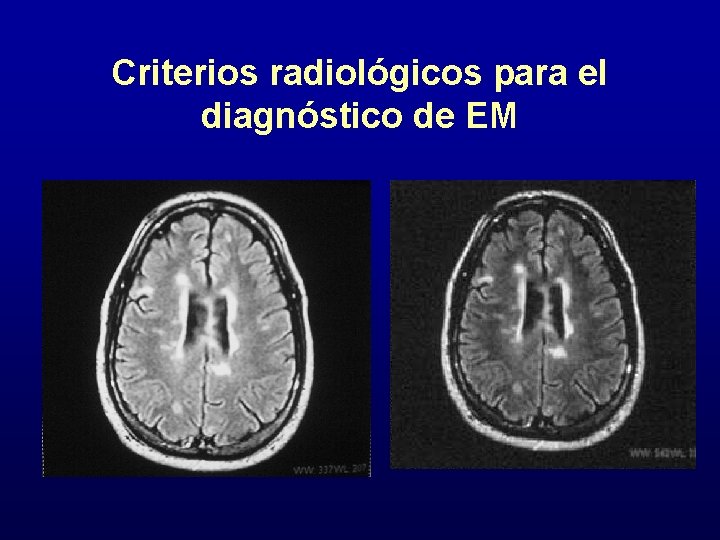 Criterios radiológicos para el diagnóstico de EM 