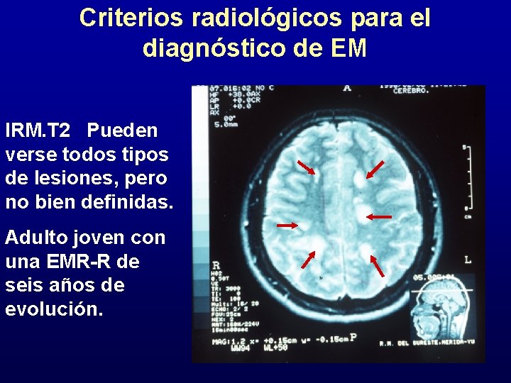 Criterios radiológicos para el diagnóstico de EM IRM. T 2 Pueden verse todos tipos