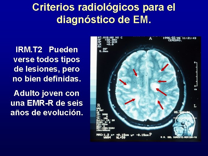 Criterios radiológicos para el diagnóstico de EM. IRM. T 2 Pueden verse todos tipos