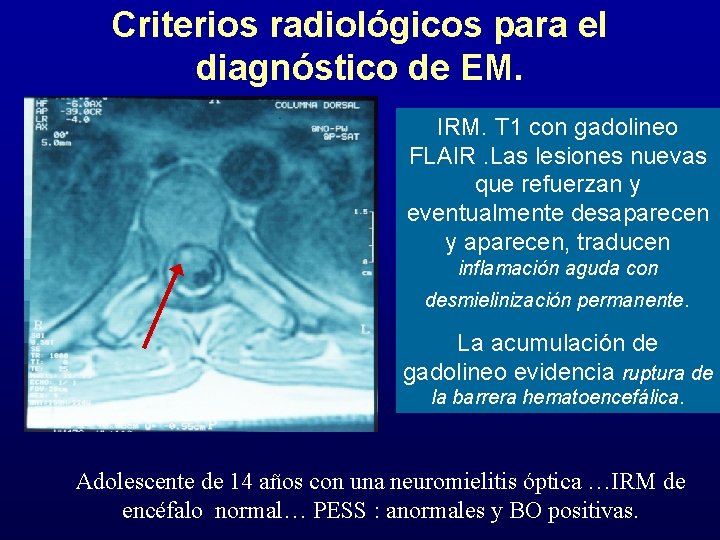Criterios radiológicos para el diagnóstico de EM. IRM. T 1 con gadolineo FLAIR. Las