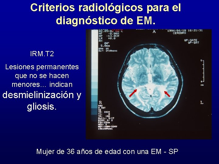 Criterios radiológicos para el diagnóstico de EM. IRM. T 2 Lesiones permanentes que no