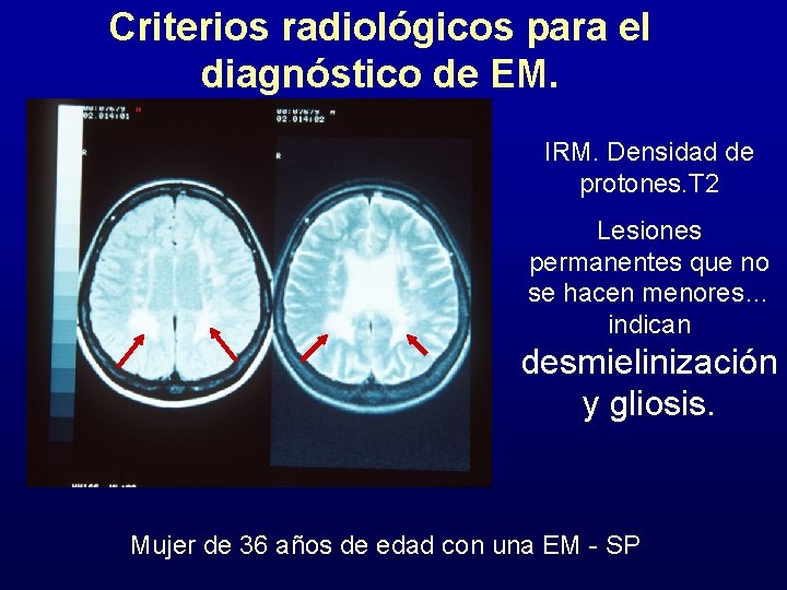 Criterios radiológicos para el diagnóstico de EM. IRM. Densidad de protones. T 2 Lesiones