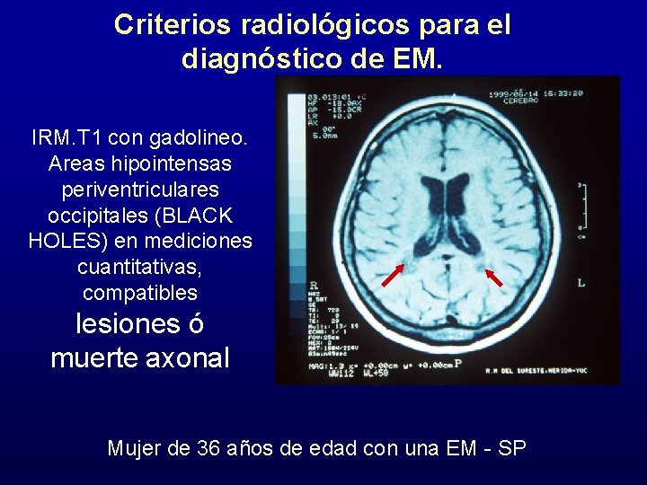 Criterios radiológicos para el diagnóstico de EM. IRM. T 1 con gadolineo. Areas hipointensas