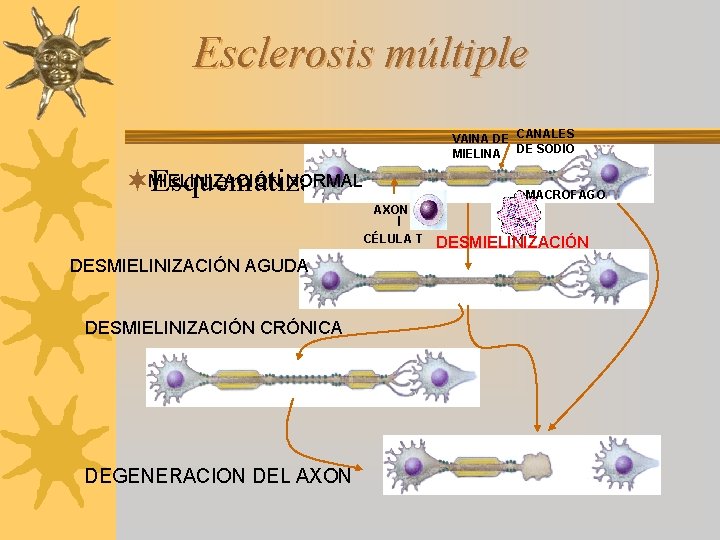 Esclerosis múltiple VAINA DE CANALES MIELINA DE SODIO NORMAL de la enfermedad ¬MIELINIZACIÓN Esquematización