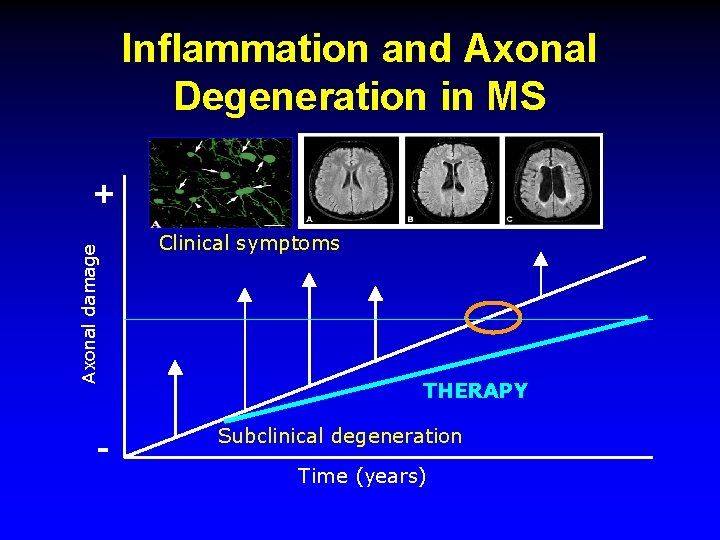 Inflammation and Axonal Degeneration in MS Axonal damage + - Clinical symptoms THERAPY Subclinical