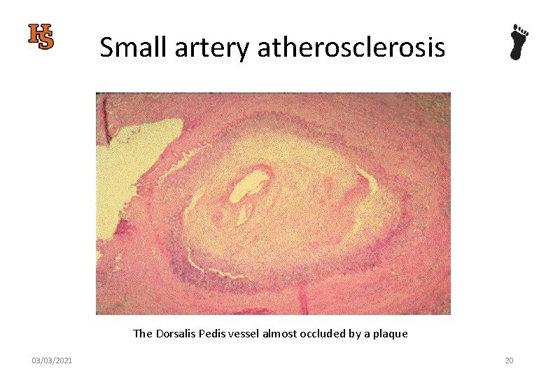 Small artery atherosclerosis The Dorsalis Pedis vessel almost occluded by a plaque 03/03/2021 20
