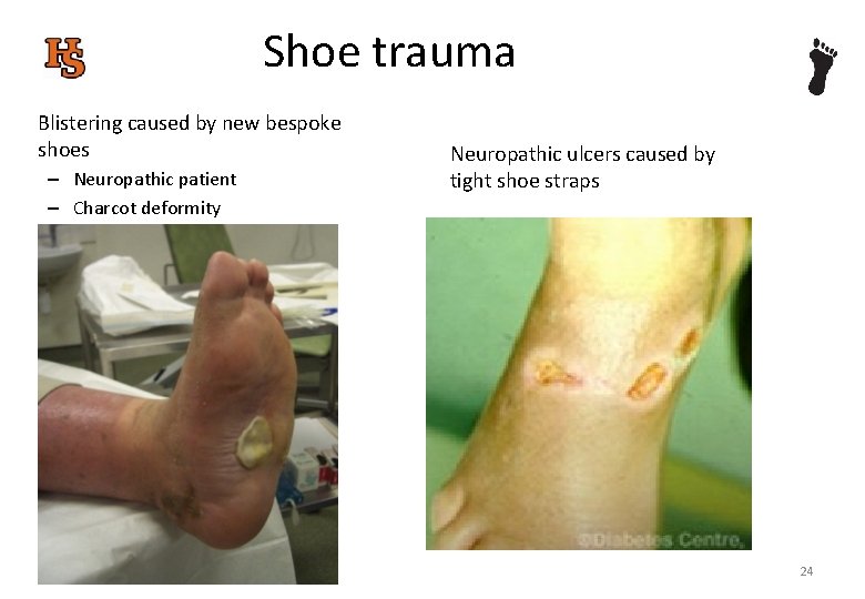 Shoe trauma Blistering caused by new bespoke shoes – Neuropathic patient – Charcot deformity