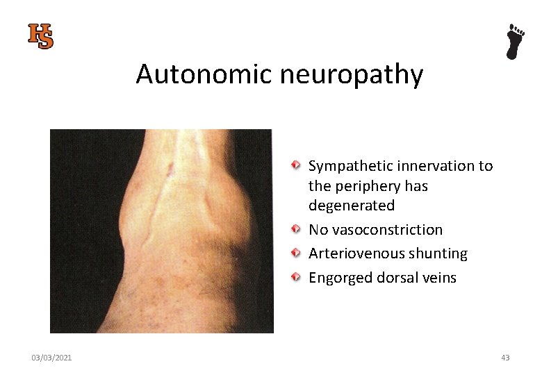 Autonomic neuropathy Sympathetic innervation to the periphery has degenerated No vasoconstriction Arteriovenous shunting Engorged