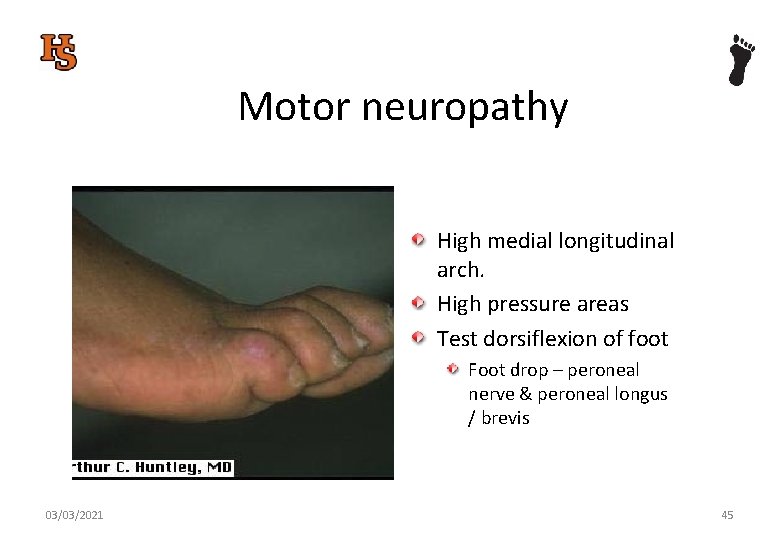 Motor neuropathy High medial longitudinal arch. High pressure areas Test dorsiflexion of foot Foot