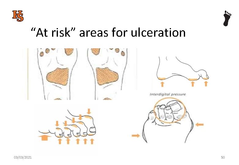 “At risk” areas for ulceration 03/03/2021 50 