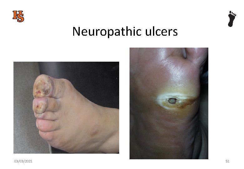 Neuropathic ulcers 03/03/2021 51 