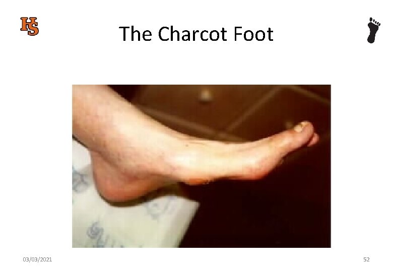 The Charcot Foot 03/03/2021 52 