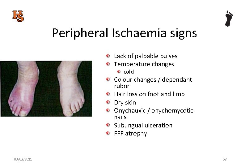 Peripheral Ischaemia signs Lack of palpable pulses Temperature changes cold Colour changes / dependant