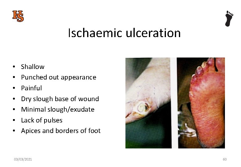 Ischaemic ulceration • • Shallow Punched out appearance Painful Dry slough base of wound