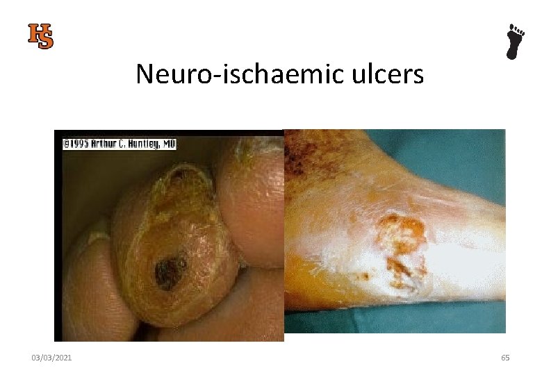 Neuro-ischaemic ulcers 03/03/2021 65 
