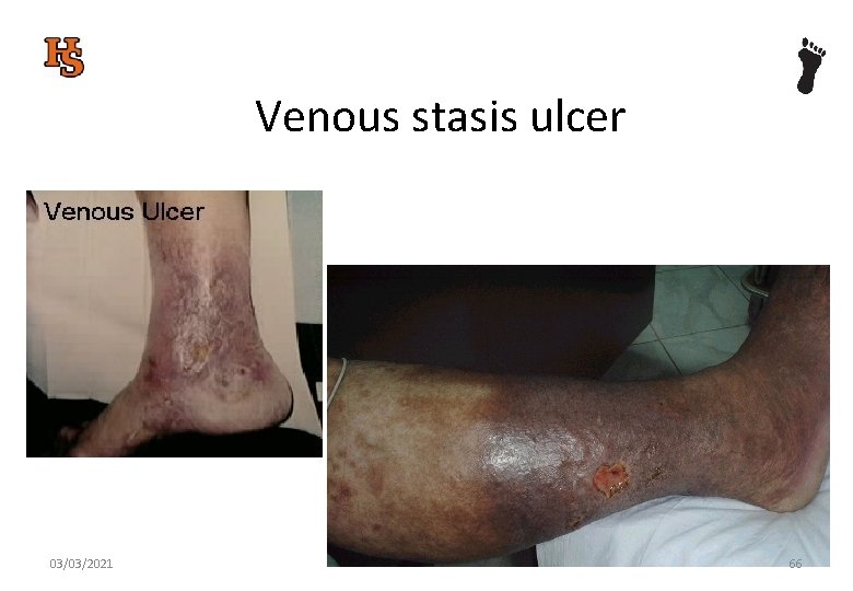 Venous stasis ulcer 03/03/2021 66 