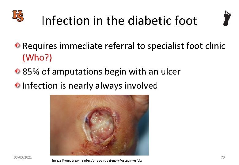 Infection in the diabetic foot Requires immediate referral to specialist foot clinic (Who? )