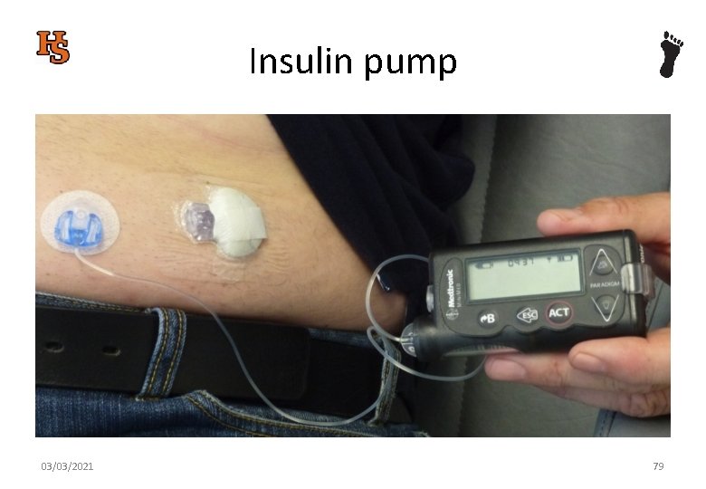 Insulin pump 03/03/2021 79 