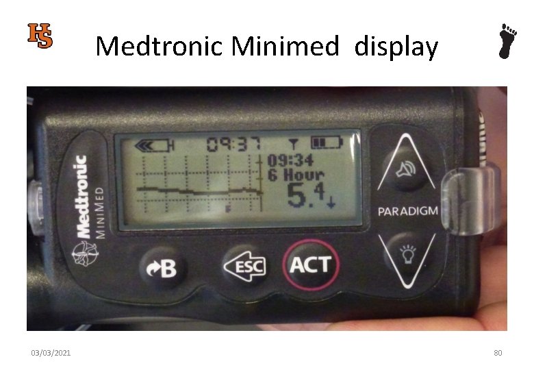 Medtronic Minimed display 03/03/2021 80 