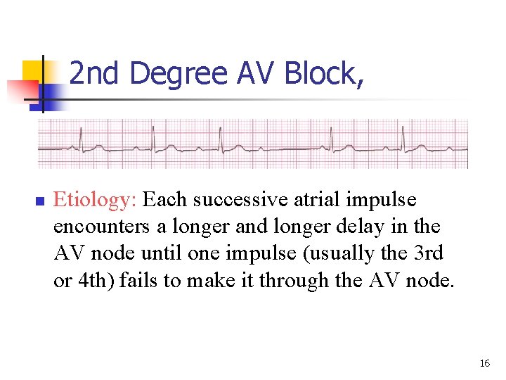 2 nd Degree AV Block, n Etiology: Each successive atrial impulse encounters a longer