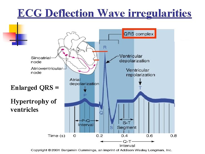 ECG Deflection Wave irregularities Enlarged QRS = Hypertrophy of ventricles 26 