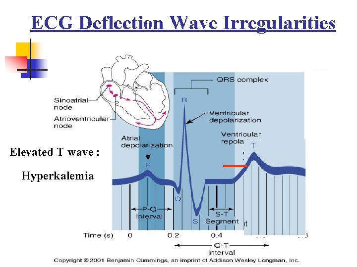 ECG Deflection Wave Irregularities Elevated T wave : Hyperkalemia 28 
