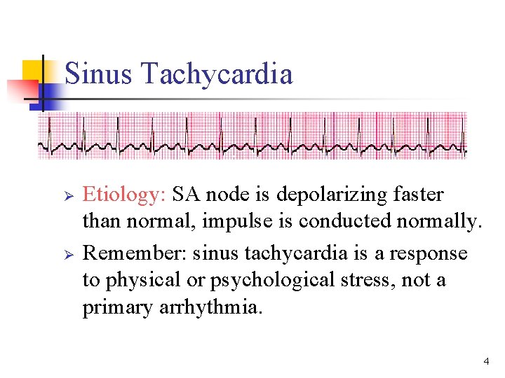 Sinus Tachycardia Ø Ø Etiology: SA node is depolarizing faster than normal, impulse is