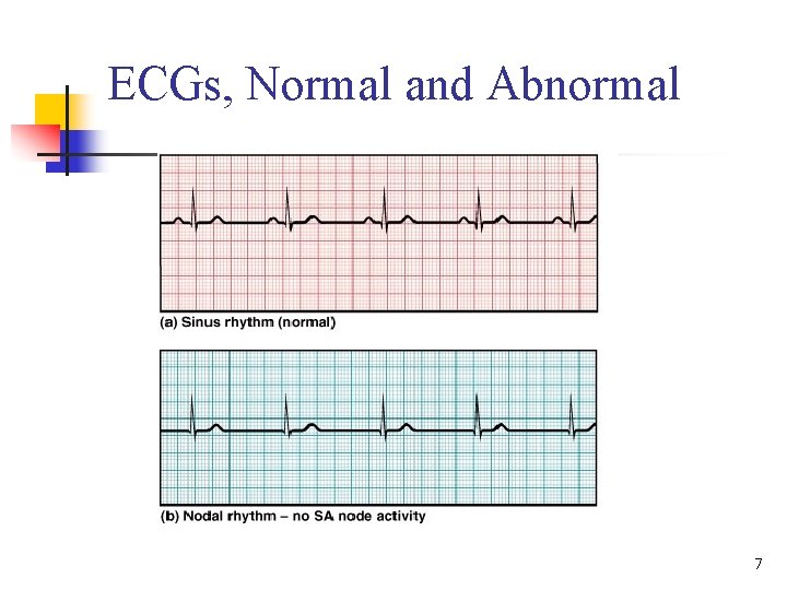 ECGs, Normal and Abnormal 7 