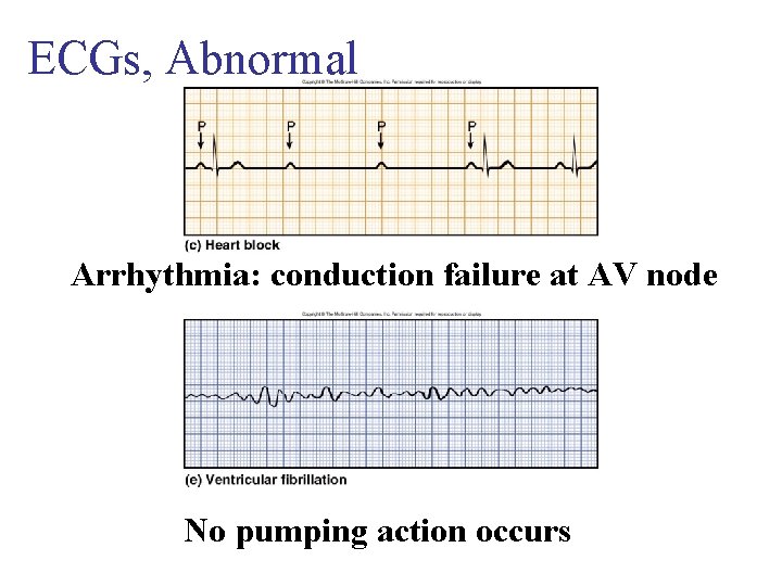 ECGs, Abnormal Arrhythmia: conduction failure at AV node No pumping action occurs 