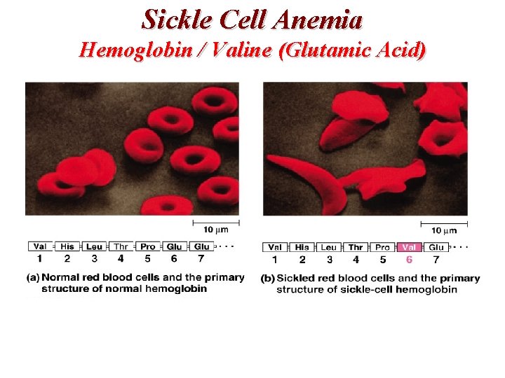 Sickle Cell Anemia Hemoglobin / Valine (Glutamic Acid) 