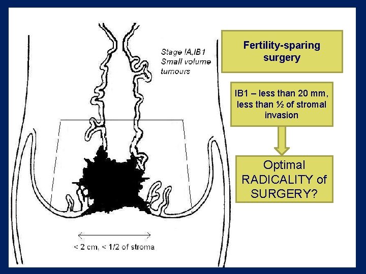 Fertility-sparing surgery IB 1 – less than 20 mm, less than ½ of stromal