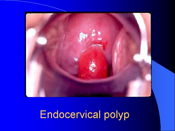 Endocervical polyp 