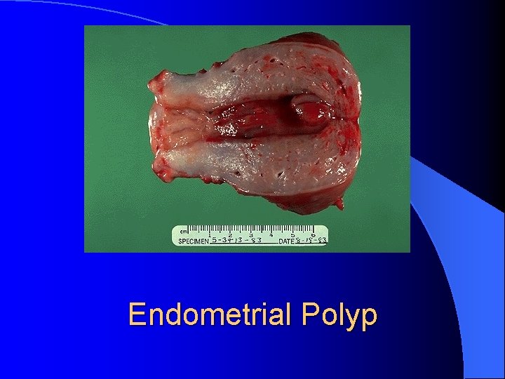 Endometrial Polyp 